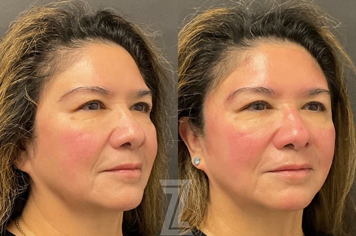 HydraFacial™ Before & After Gallery - Patient 384379 - Image 2