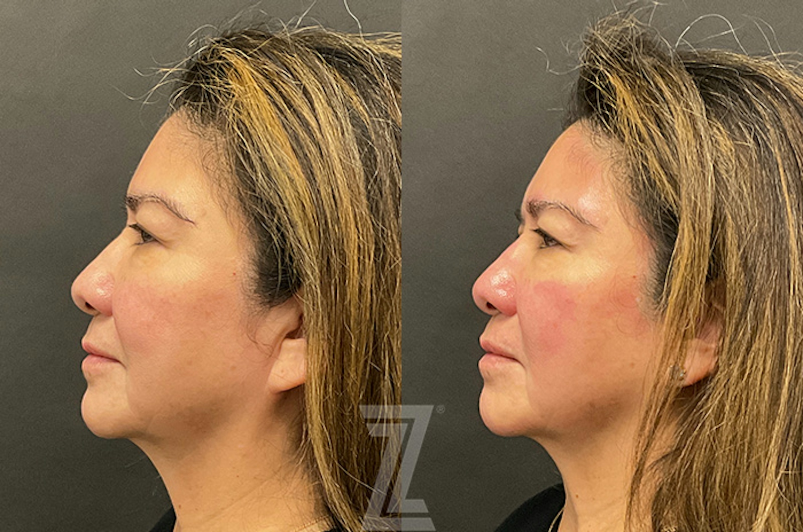 Austin HydraFacial™ Before & After Gallery - Patient 384379 - Image 5 - The Piazza Center