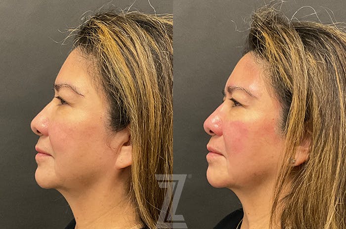 HydraFacial™ Before & After Gallery - Patient 384379 - Image 5