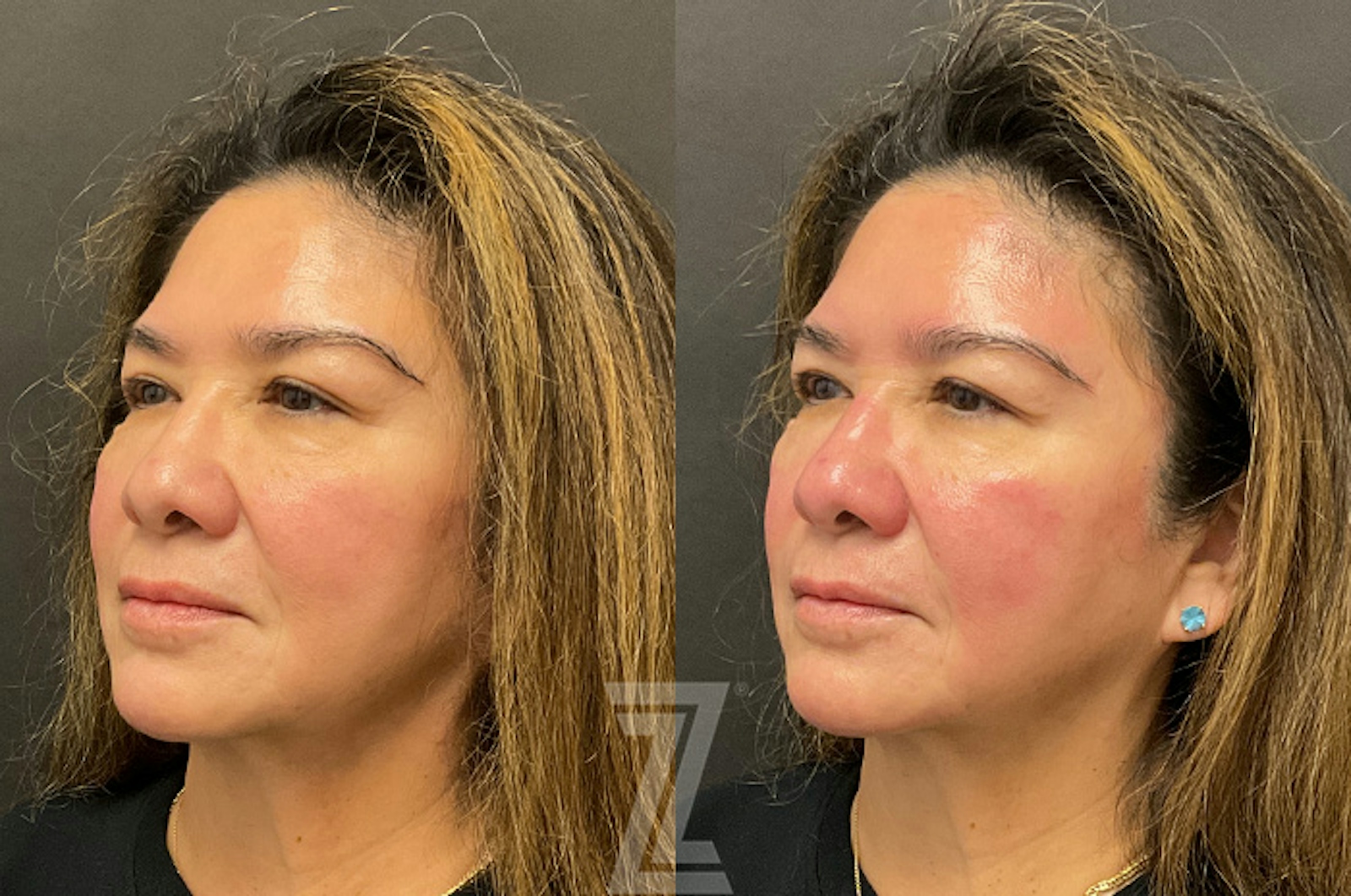 Austin HydraFacial™ Before & After Gallery - Patient 384379 - Image 4 - The Piazza Center