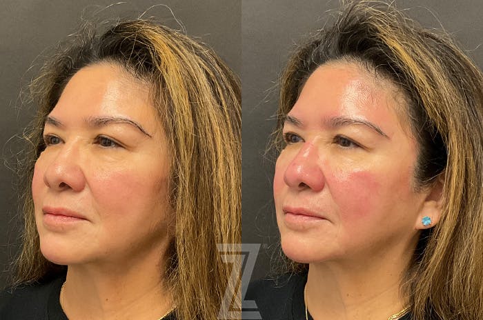 HydraFacial™ Before & After Gallery - Patient 384379 - Image 4
