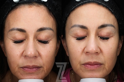 Profound® RF Microneedling Before & After Gallery - Patient 287430 - Image 1