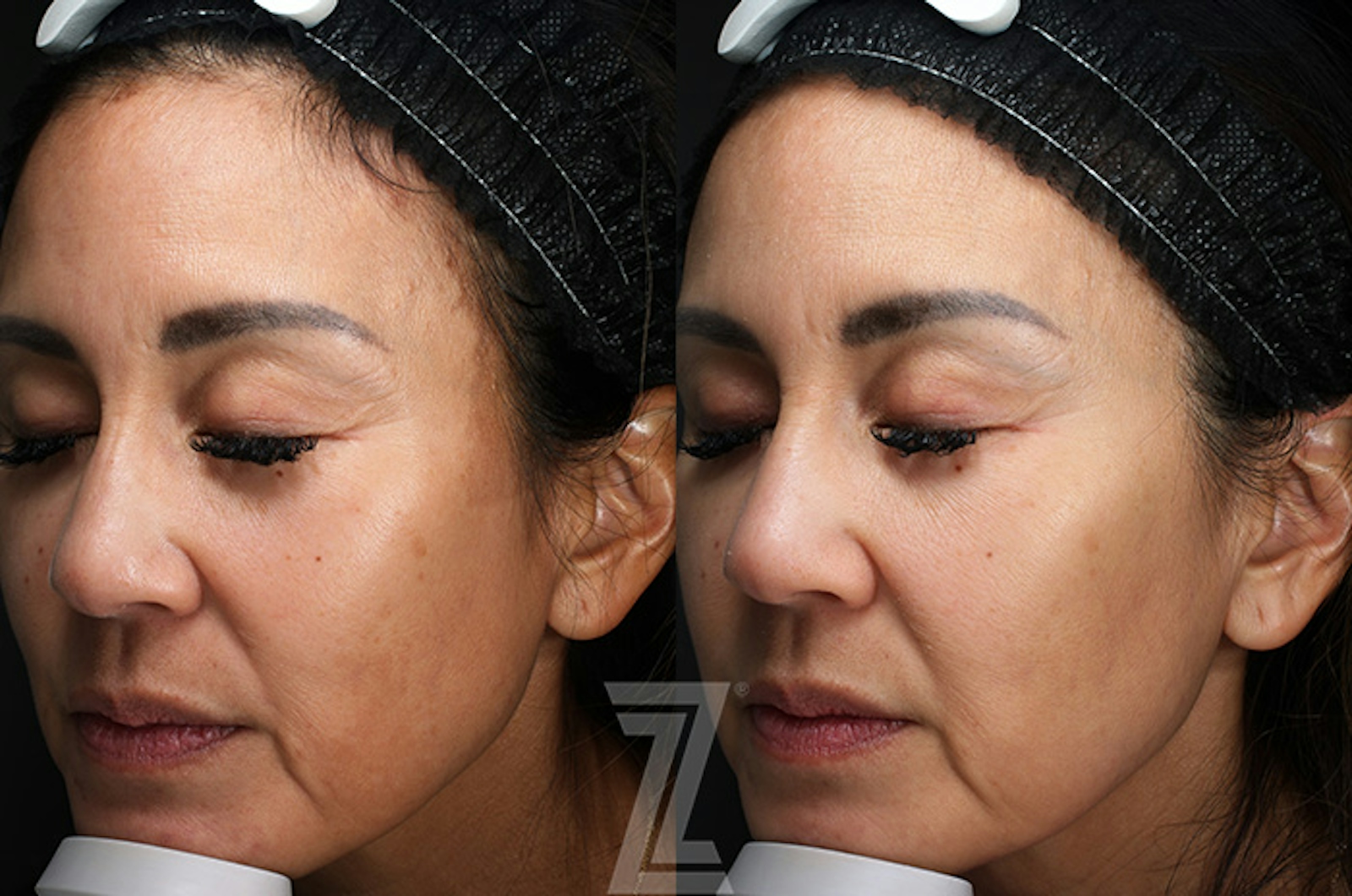 Austin SkinPen Microneedling Before & After Gallery - Patient 324647 - Image 3 - The Piazza Center