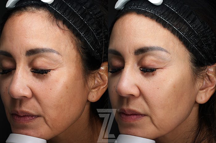 Profound® RF Microneedling Before & After Gallery - Patient 287430 - Image 3