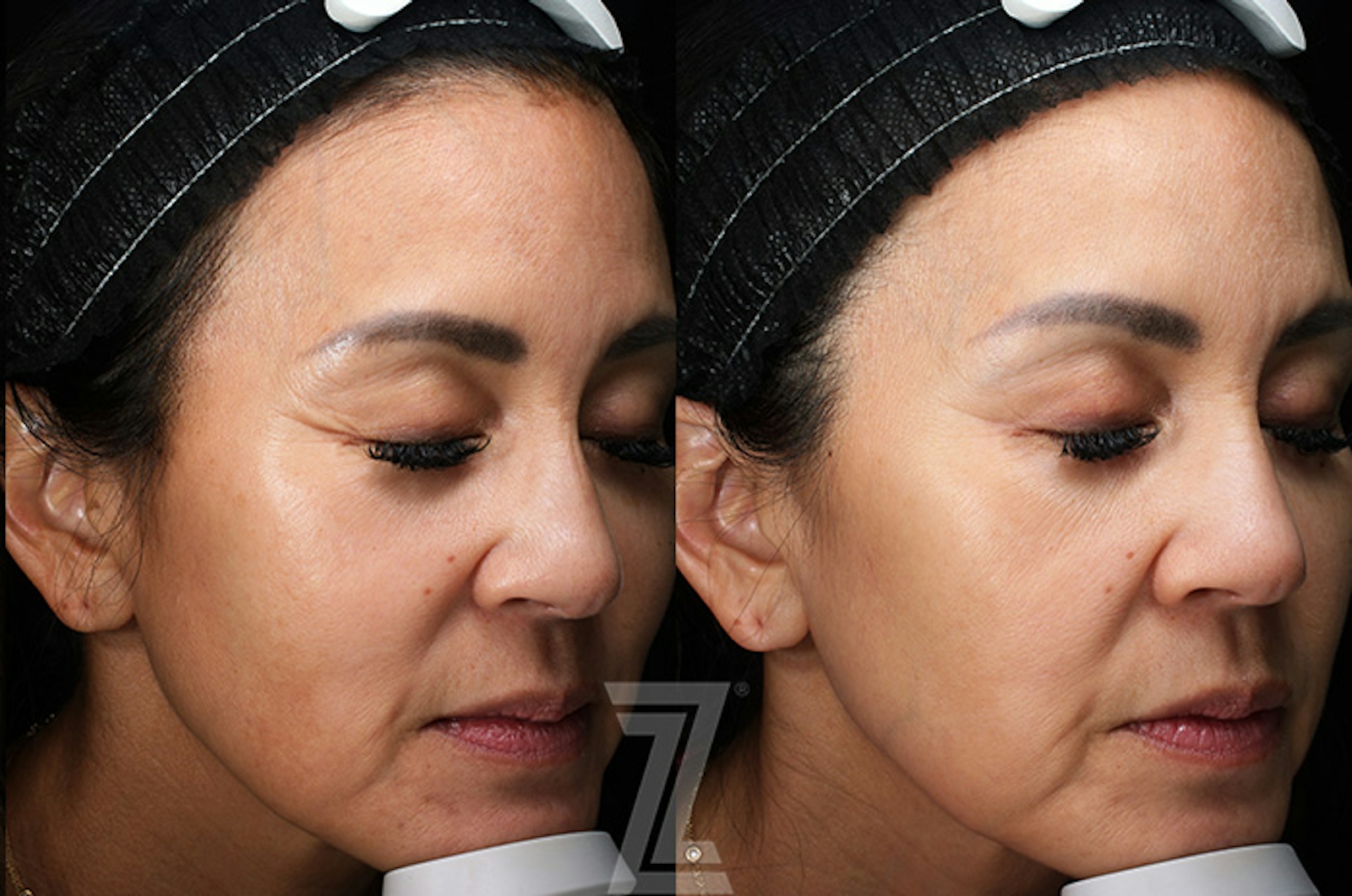 Austin SkinPen Microneedling Before & After Gallery - Patient 324647 - Image 2 - The Piazza Center