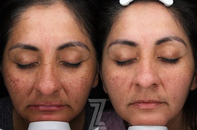 Austin Moxi Before & After Gallery - Patient 192906 - Image 1 - The Piazza Center