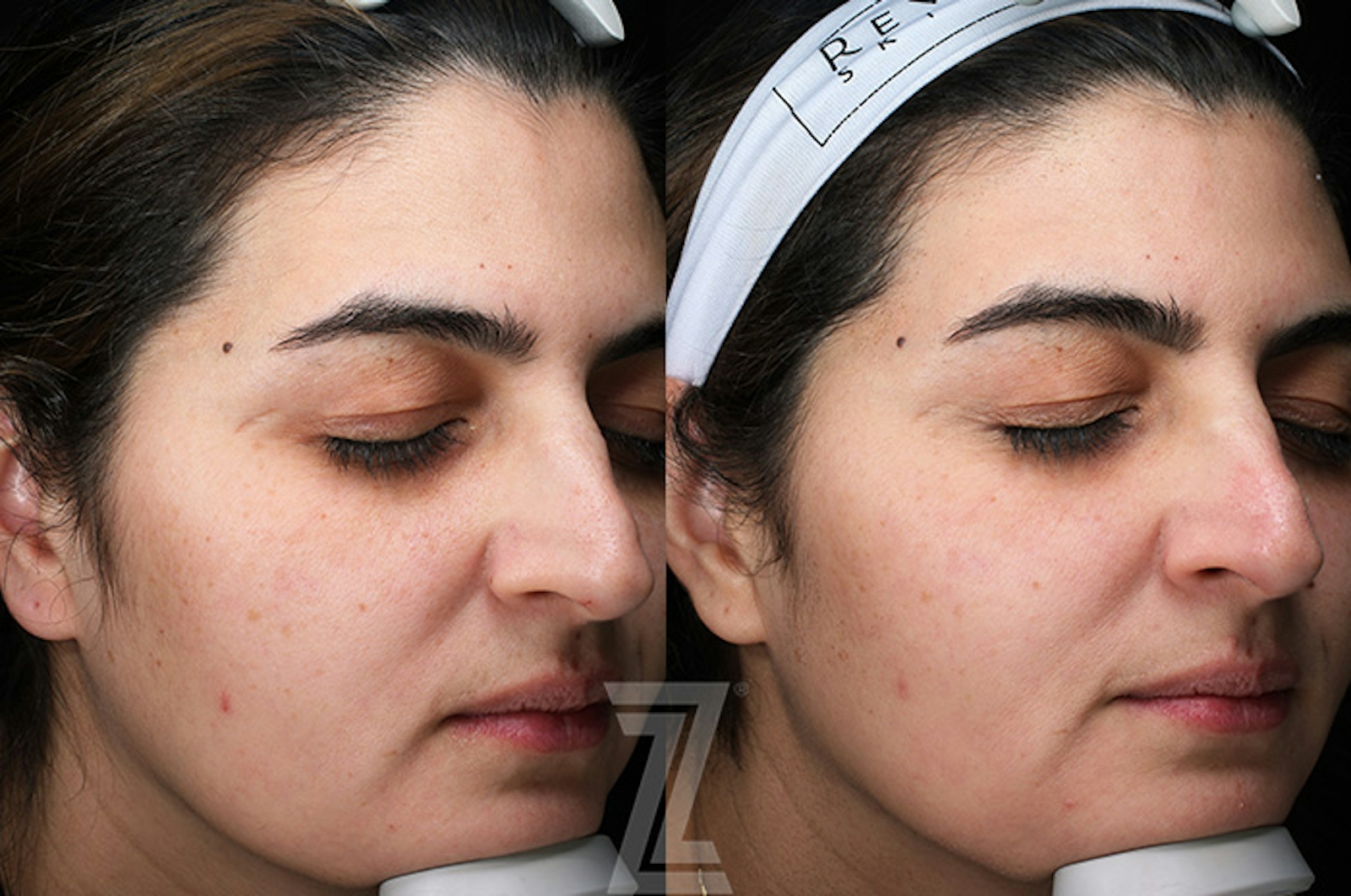 Austin Moxi Before & After Gallery - Patient 216408 - Image 2 - The Piazza Center