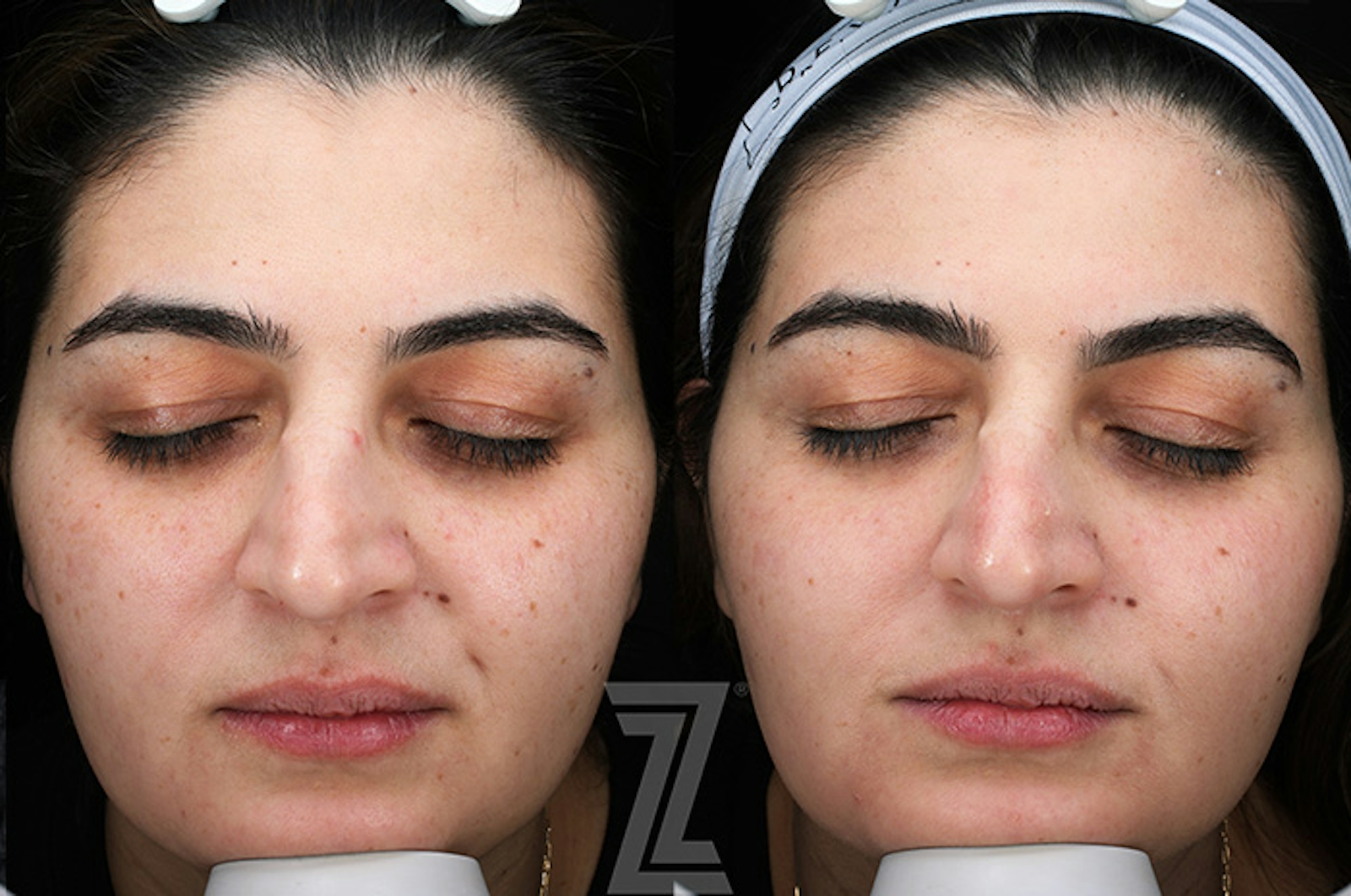 Austin Moxi Before & After Gallery - Patient 216408 - Image 1 - The Piazza Center