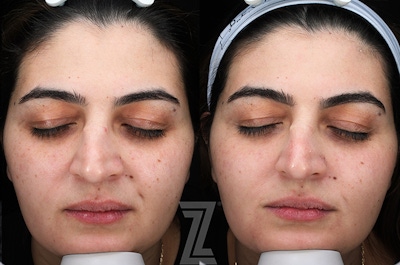 Moxi Before & After Photos | The Piazza Center