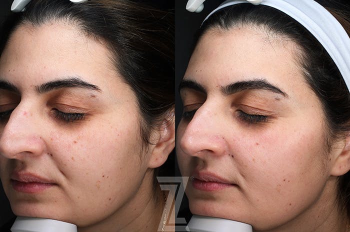 Moxi Before & After Gallery - Patient 216408 - Image 3