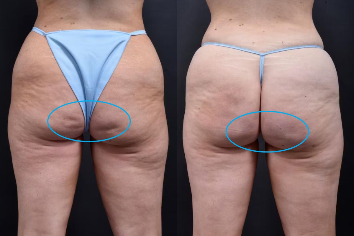 Piazza Center Patient Aveli cellulite before and after