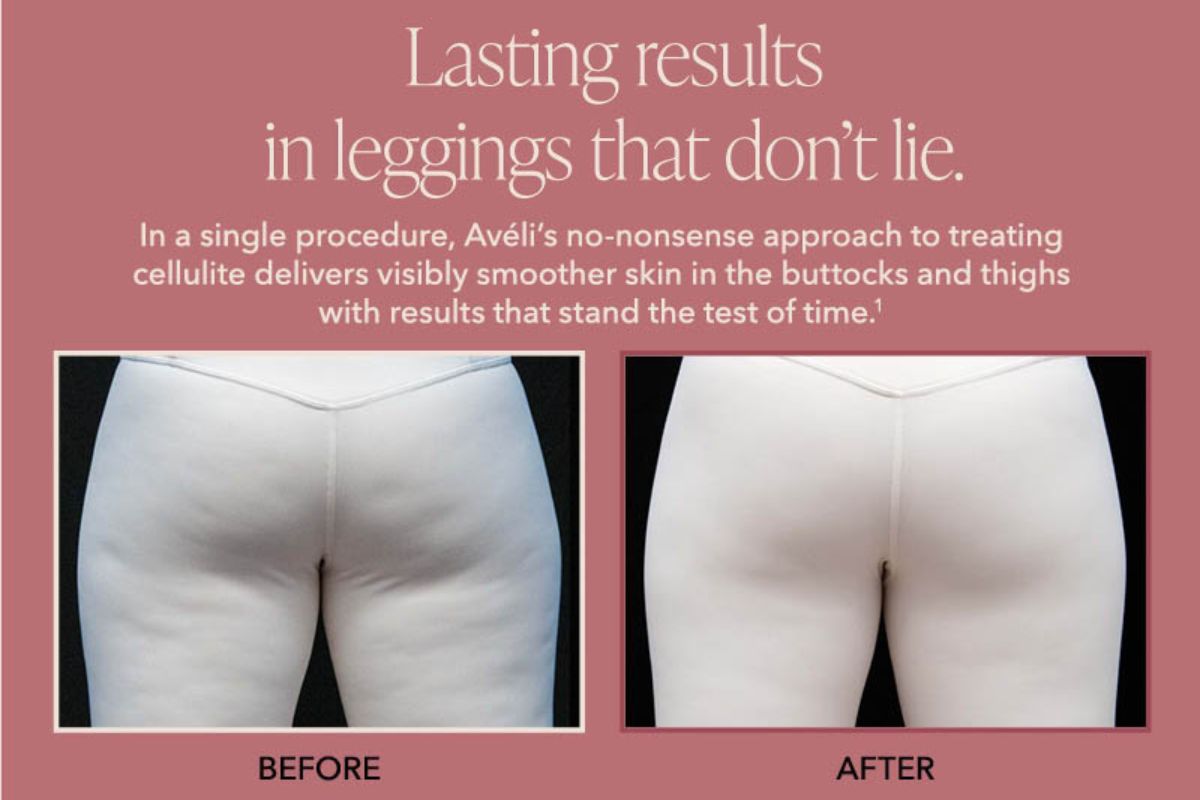 Woman in leggings before and after aveli procedure for cellulite