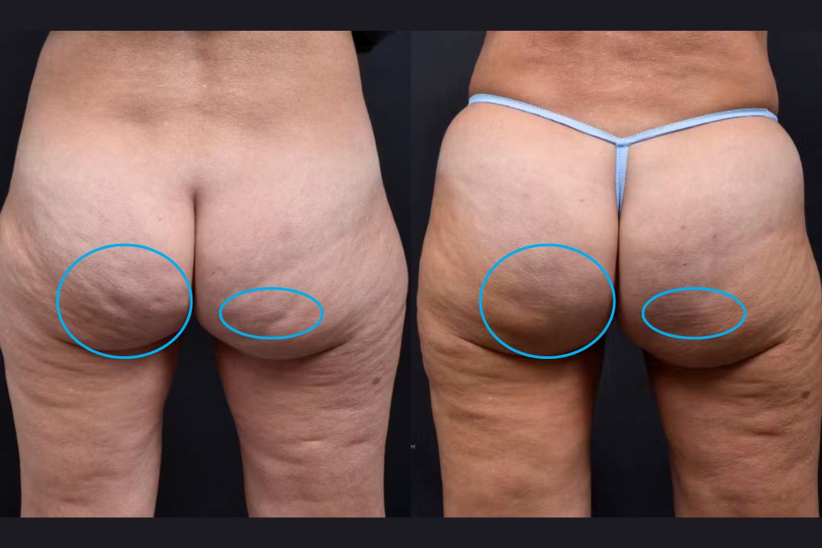 Woman butt cellulite before and after Aveli