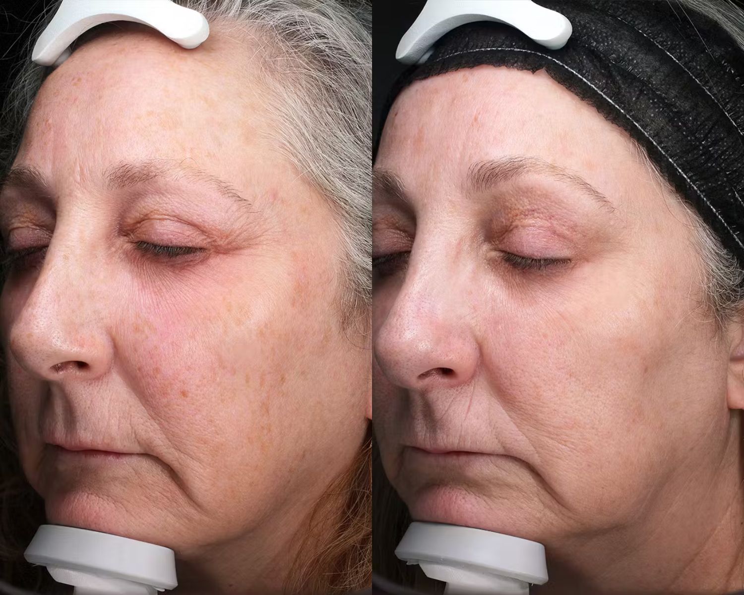 Older woman before and after photos of Sciton StaX laser treatments