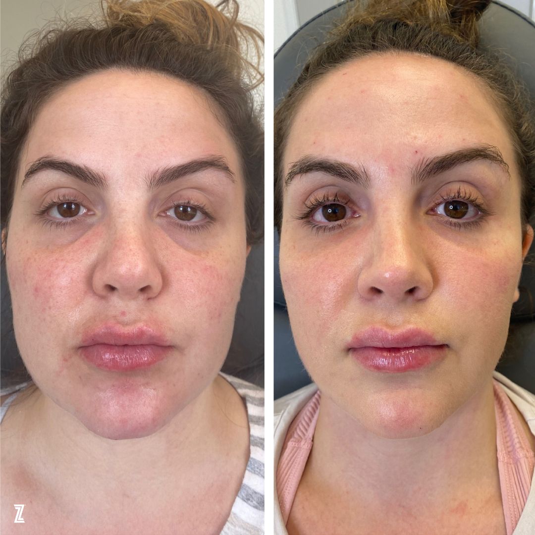 before and after full facial balancing results