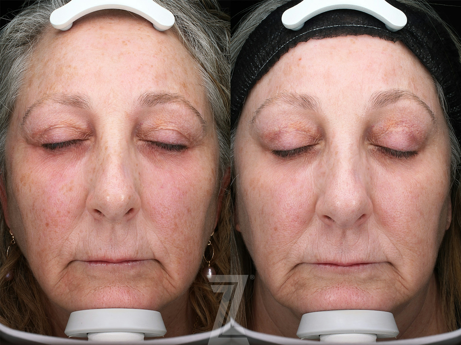 Austin BBL Before & After Gallery - Patient 160628 - Image 1 - The Piazza Center