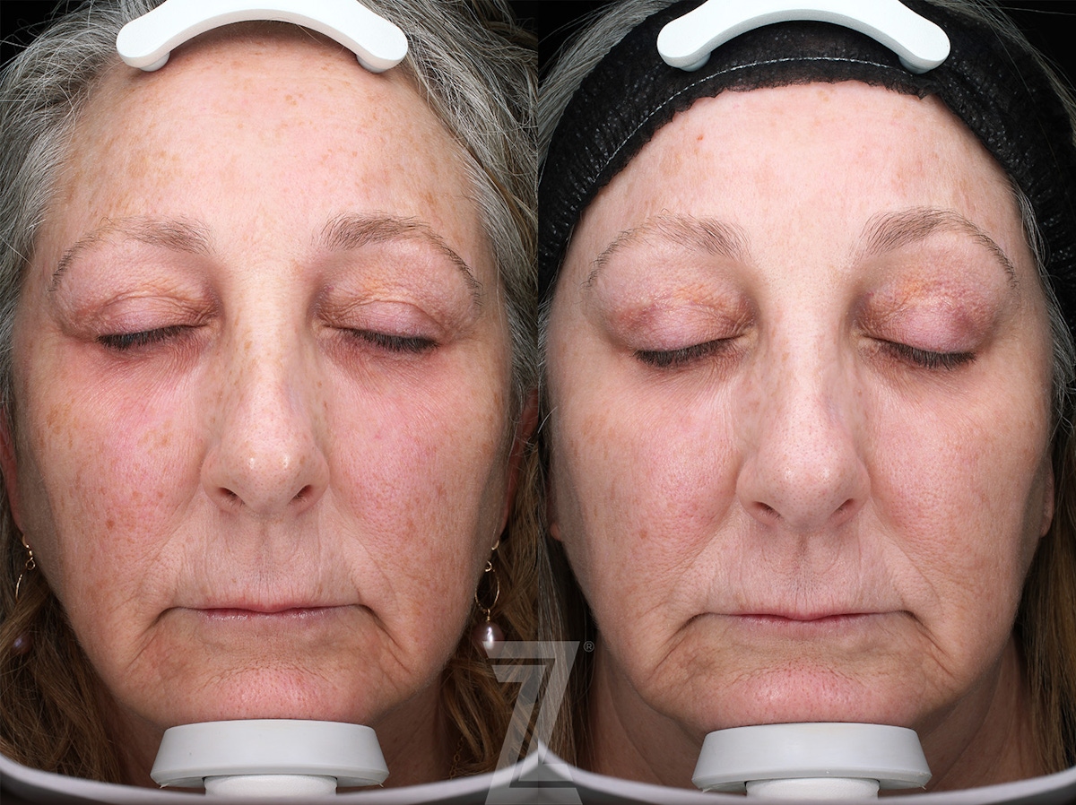 Austin BBL Before & After Gallery - Patient 160628 - Image 1 - The Piazza Center