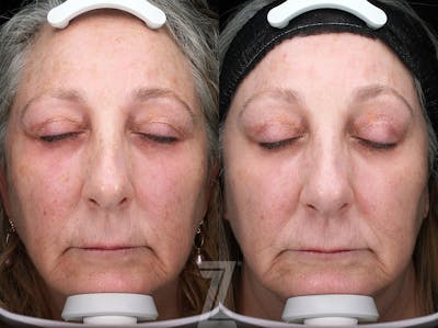 Austin BBL Before & After Gallery - Patient 160628 - Image 1 - The Piazza Center