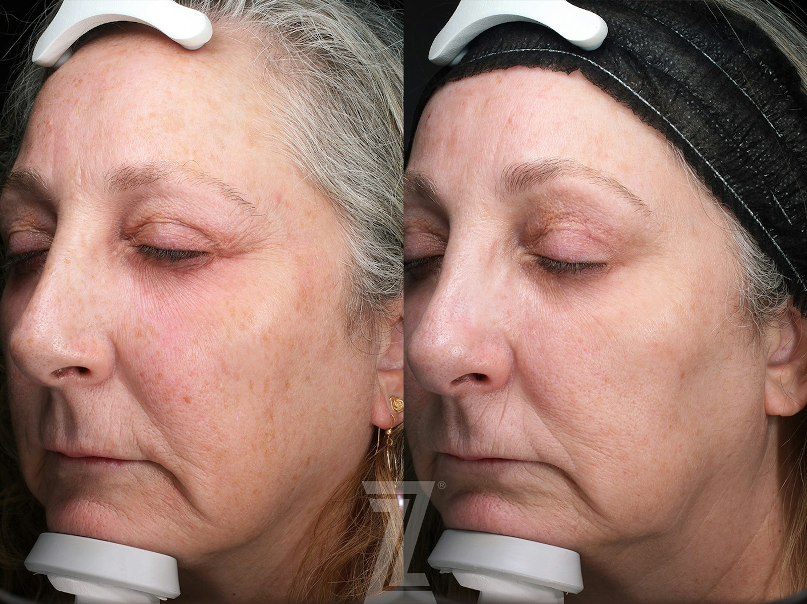 Austin BBL Before & After Gallery - Patient 160628 - Image 2 - The Piazza Center