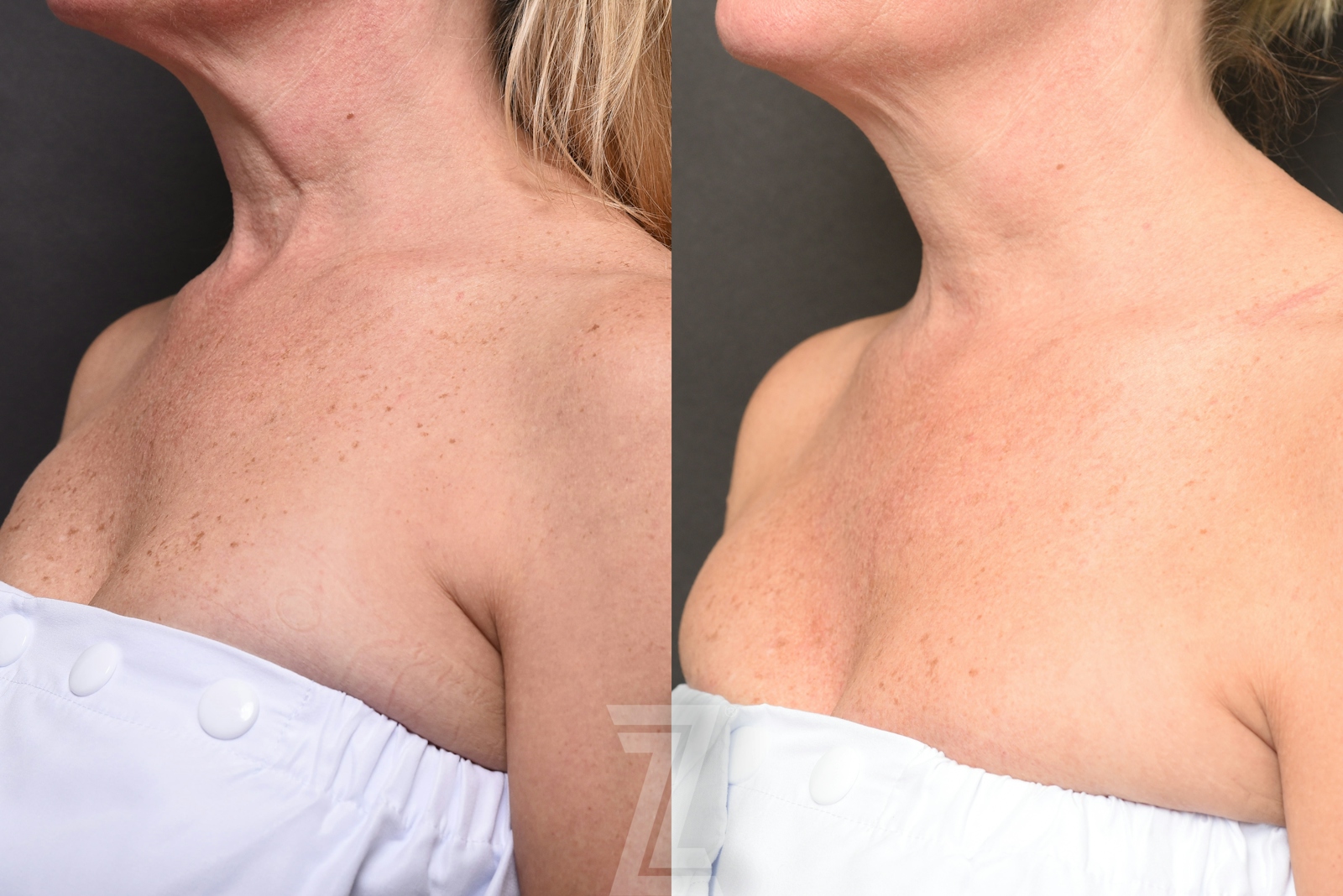 Austin HALO Before & After Gallery - Patient 327066 - Image 2 - The Piazza Center