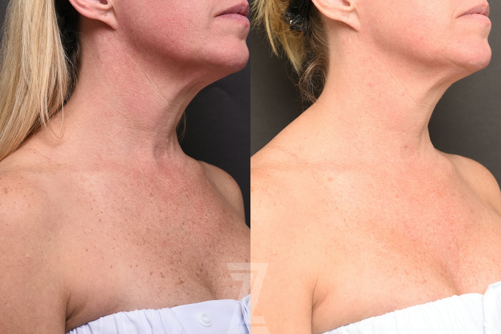 Austin HALO Before & After Gallery - Patient 327066 - Image 3 - The Piazza Center