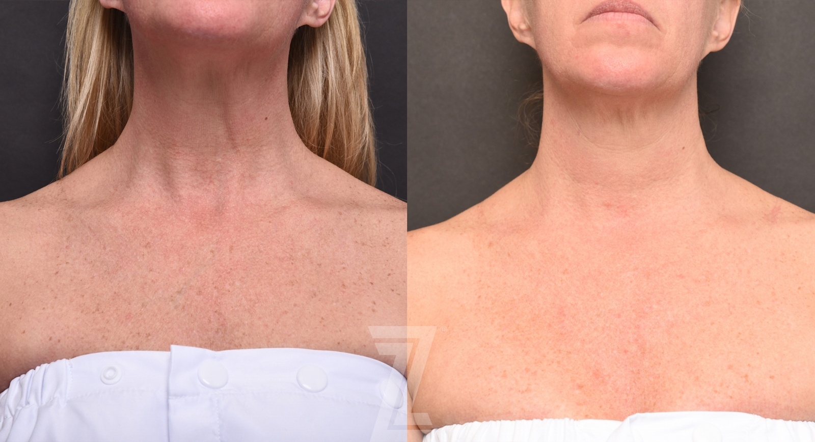 Austin HALO Before & After Gallery - Patient 327066 - Image 1 - The Piazza Center