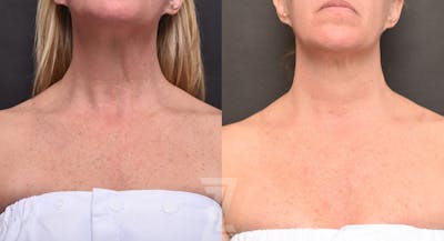 Austin BBL Before & After Gallery - Patient 138650 - Image 1 - The Piazza Center