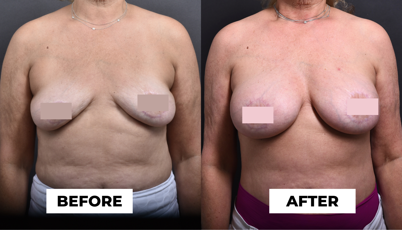 Breasts Before and After Fat Transfer + Implants