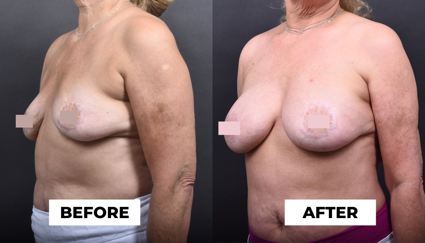 Before and After - Breast Implant + Fat Transfer