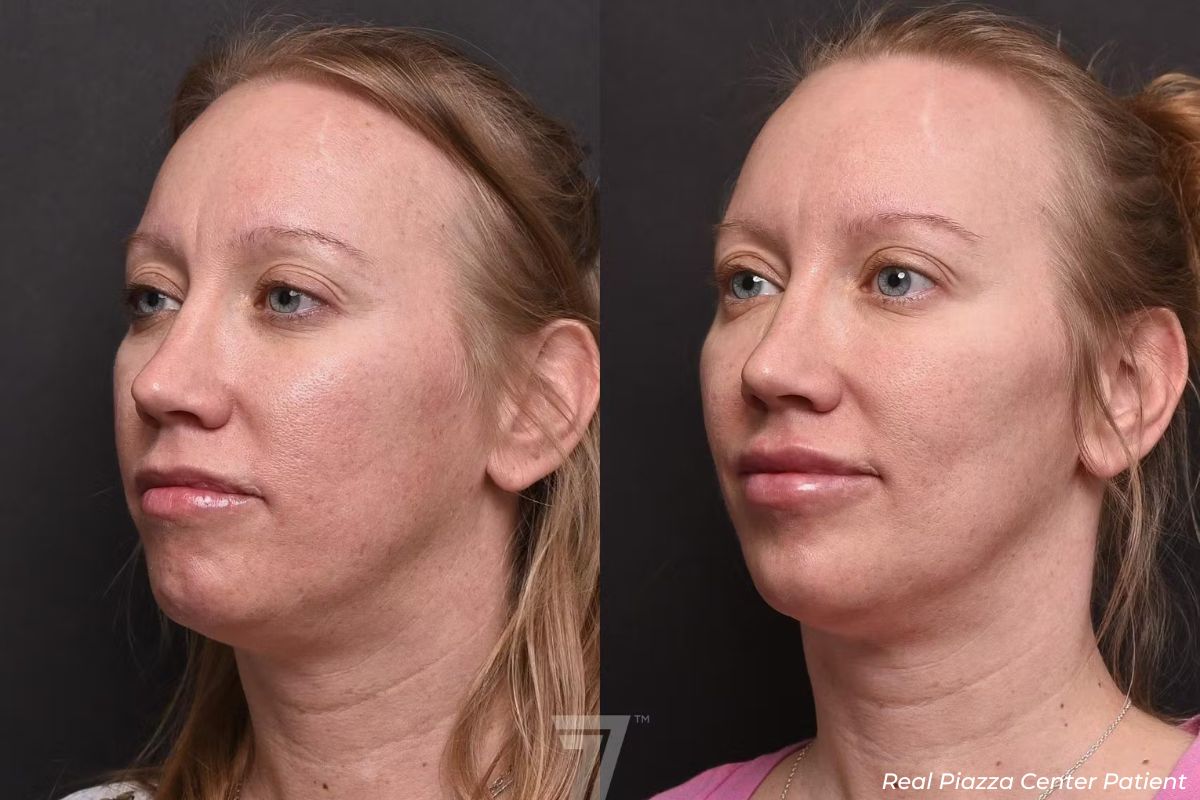 Full Face Rejuvenation Before and After