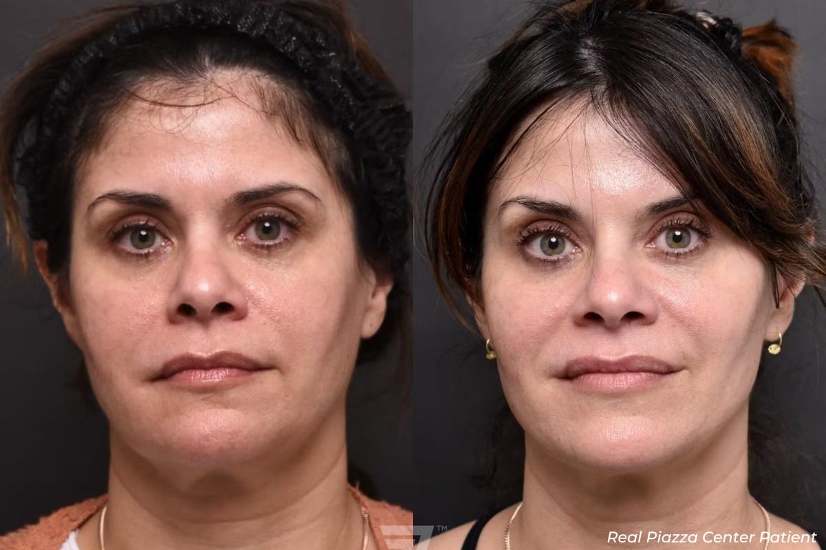 Before and After Facial Balancing Austin TX