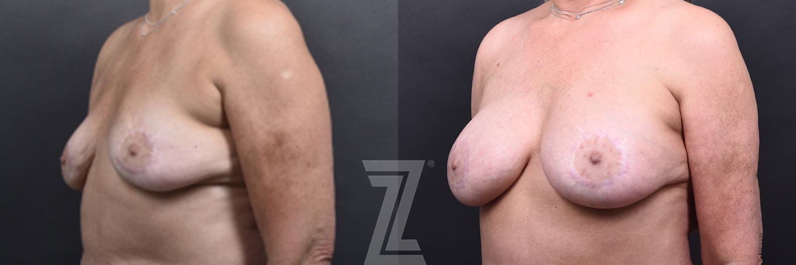 Austin Fat Transfer Breast Augmentation Before & After Gallery - Patient 311307 - Image 2 - The Piazza Center