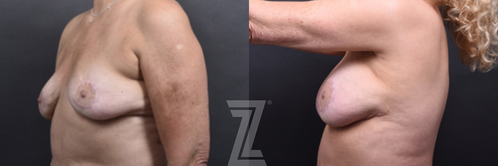 Austin Fat Transfer Breast Augmentation Before & After Gallery - Patient 311307 - Image 3 - The Piazza Center
