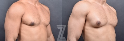 Male Breast Reduction Before & After Gallery - Patient 104454 - Image 1