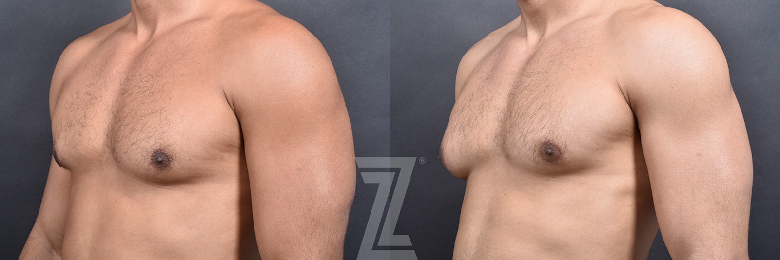 Austin Male Breast Reduction Before & After Gallery - Patient 104454 - Image 2 - The Piazza Center