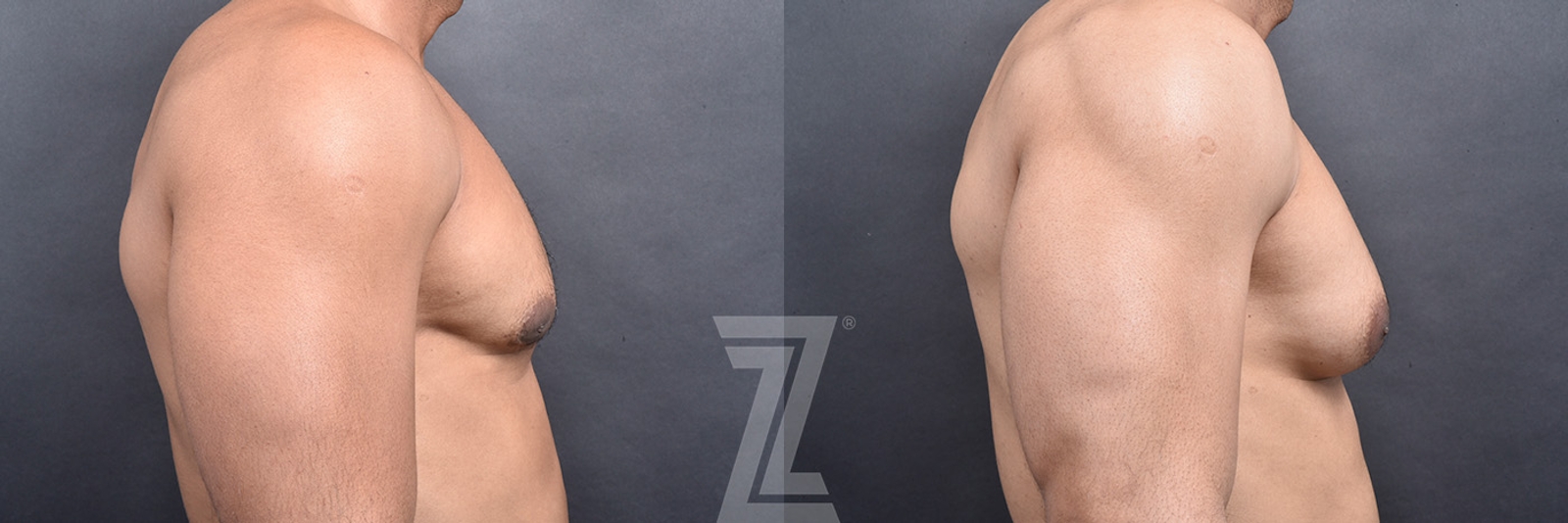 Austin Male Breast Reduction Before & After Gallery - Patient 104454 - Image 3 - The Piazza Center