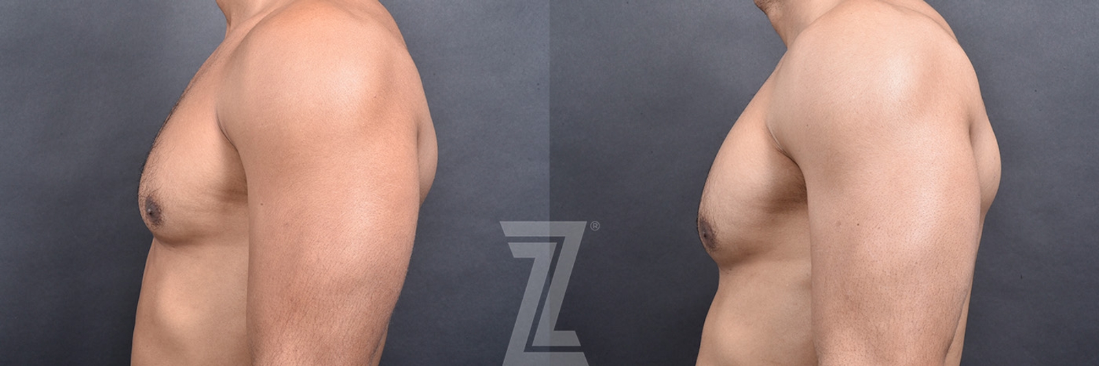 Austin Male Breast Reduction Before & After Gallery - Patient 104454 - Image 4 - The Piazza Center