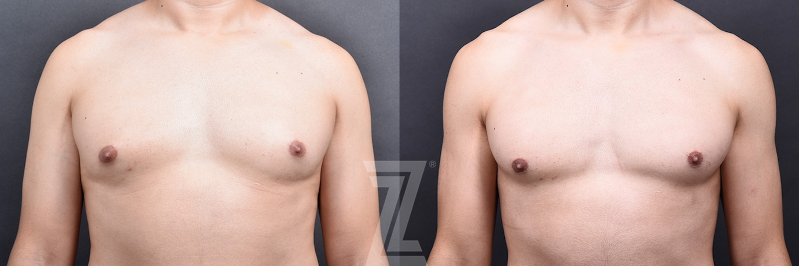 Austin Male Breast Reduction Before & After Gallery - Patient 348353 - Image 1 - The Piazza Center