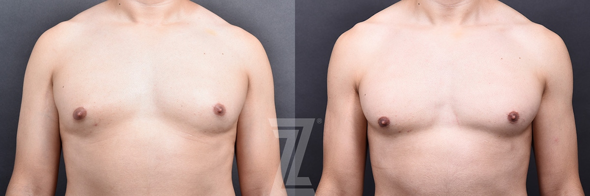 Austin Male Breast Reduction Before & After Gallery - Patient 348353 - Image 1 - The Piazza Center