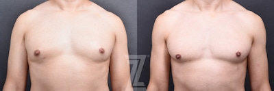 Male Breast Reduction Before & After Gallery - Patient 348353 - Image 1