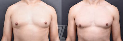 Austin Male Breast Reduction Before & After Gallery - Patient 348353 - Image 1 - The Piazza Center