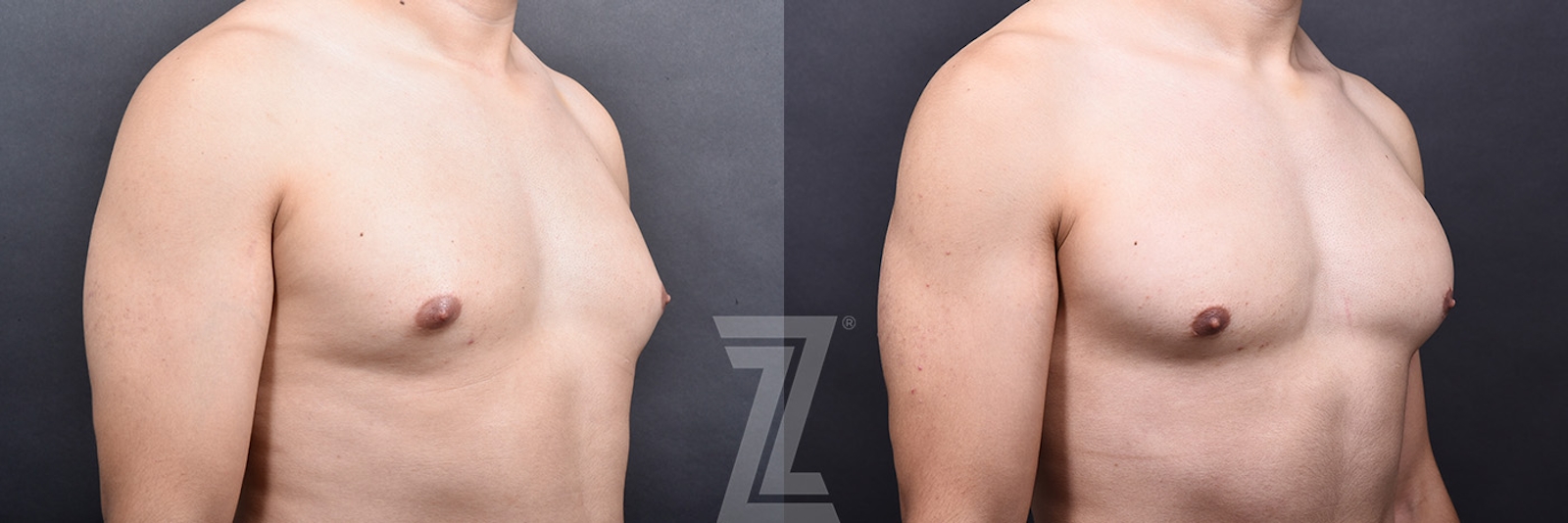 Austin Male Breast Reduction Before & After Gallery - Patient 348353 - Image 2 - The Piazza Center