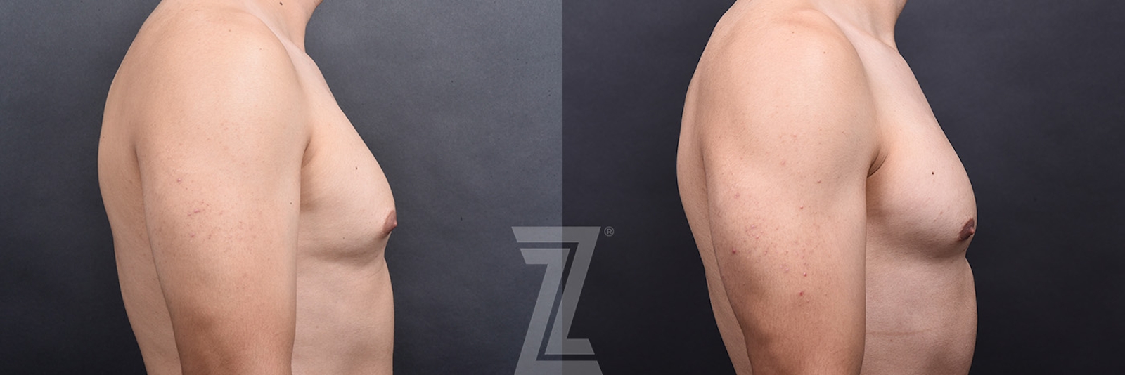 Austin Male Breast Reduction Before & After Gallery - Patient 348353 - Image 3 - The Piazza Center