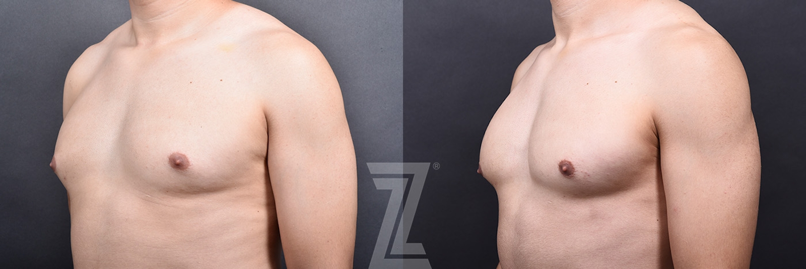 Austin Male Breast Reduction Before & After Gallery - Patient 348353 - Image 4 - The Piazza Center