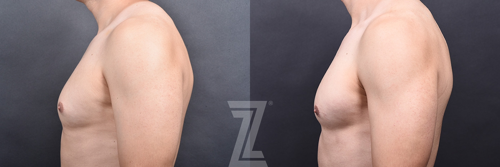 Austin Male Breast Reduction Before & After Gallery - Patient 348353 - Image 5 - The Piazza Center