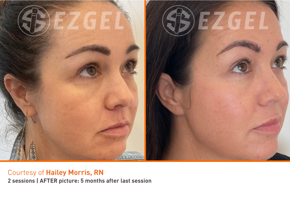 under eye results with ezGEL