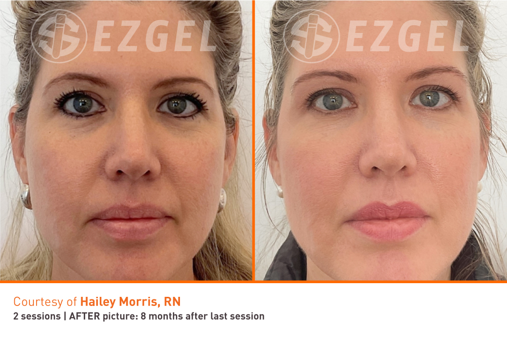 ezGEL Results