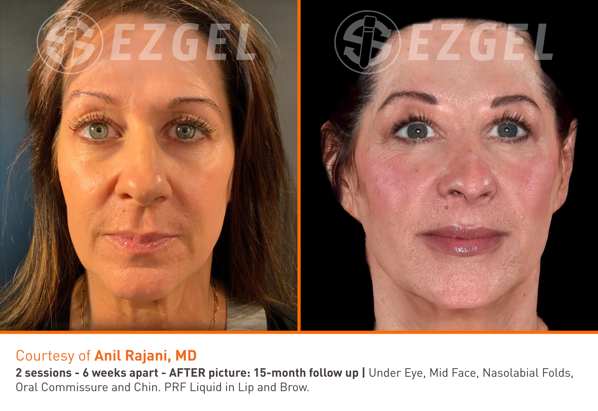 before and after results from ezGEL