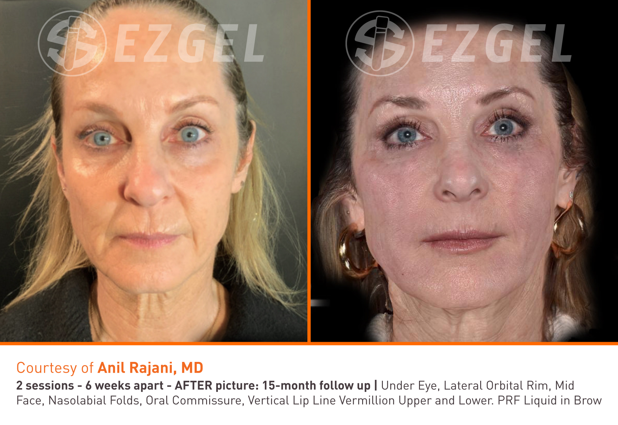 Results from ezGEL