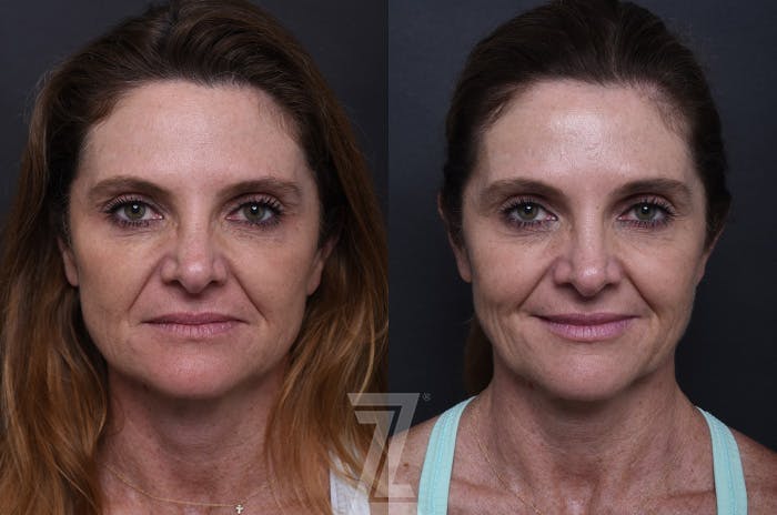 ezGEL before and after photo